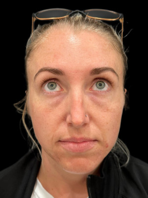 Before Image: Cheek and Chin Filler with Katelyn, RN - front