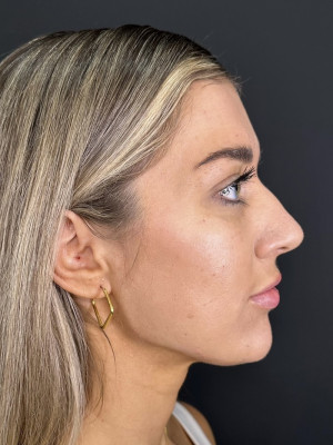 After Image: Jaw and Chin Filler with Katelyn, RN - other