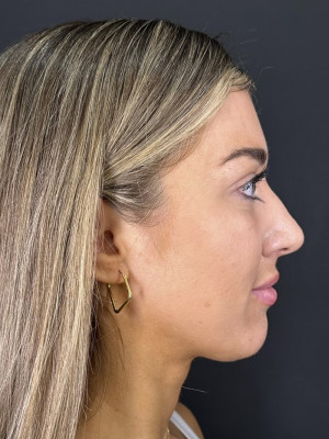 Before Image: Jaw and Chin Filler with Katelyn, RN - other