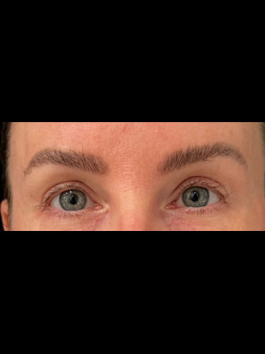 After Image: Case # 7509 – Upper Blepharoplasty - front