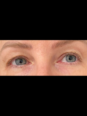 Before Image: Case # 7509 – Upper Blepharoplasty - front