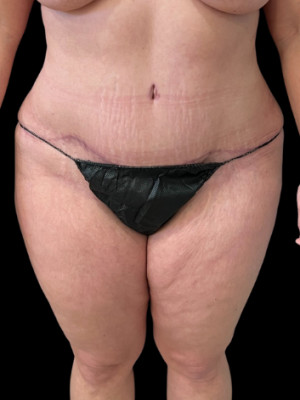 Case #7517 – SAFElipo Circ Trunk, Abdominoplasty