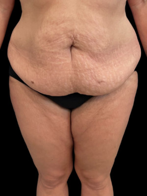 Case #7517 – SAFElipo Circ Trunk, Abdominoplasty