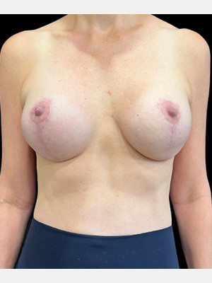 Case #7523 – Breast Lift with Augmentation
