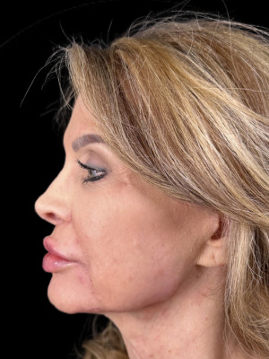 After Image: Before Jaw filler and Lip filler with Katelyn - left-side