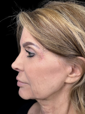 Before Image: Before Jaw filler and Lip filler with Katelyn - left-side
