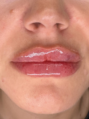 After Image: Lip Filler with Katelyn - other
