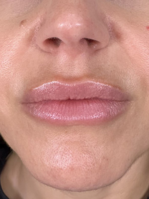 Before Image: Lip Filler with Katelyn - other