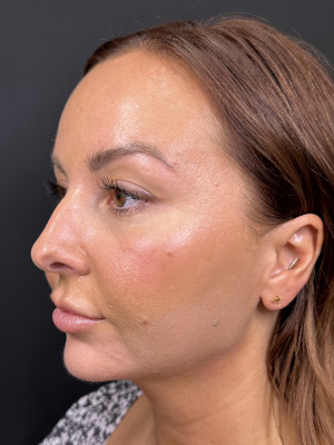 After Image: MyEllevate and Jawline Filler - left-front-oblique