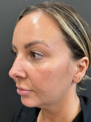 Before Image: MyEllevate and Jawline Filler - left-front-oblique