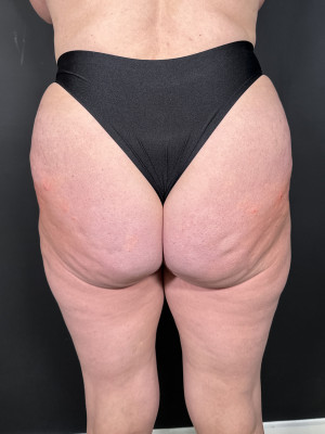 After Image: Non-Surgical BBL by Katelyn, RN - back