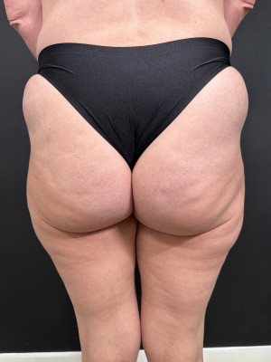 Before Image: Non-Surgical BBL by Katelyn, RN - back
