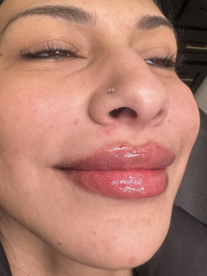 After Image: Lip Filler with Katleyn, RN - right-front-oblique