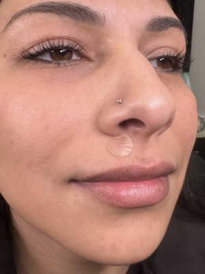 Before Image: Lip Filler with Katleyn, RN - right-front-oblique