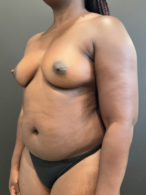 Before Image: Case #7673 – Breast Augmentation - left-front-oblique
