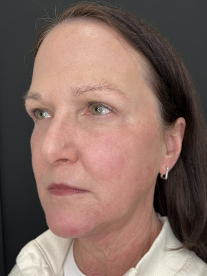 After Image: Upper and Lower Bleph, Fat grafting face with Dr. Walker & Trifecta Rf with Paul Kraft - left-front-oblique
