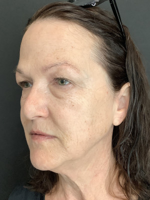 Before Image: Upper and Lower Bleph, Fat grafting face with Dr. Walker & Trifecta Rf with Paul Kraft - left-front-oblique
