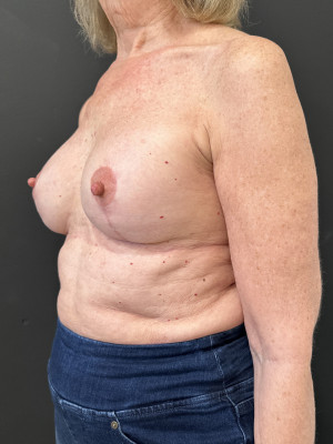 After Image: Case #7709 – Breast Lift with Augmentation - left-front-oblique
