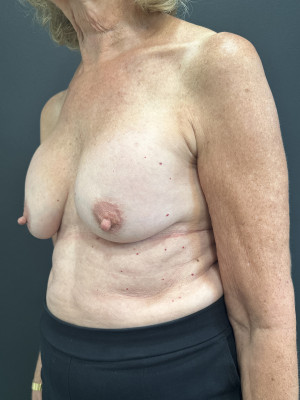 Before Image: Case #7709 – Breast Lift with Augmentation - left-front-oblique
