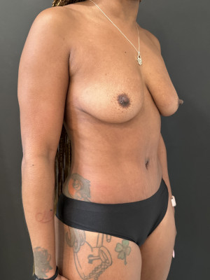 After Image: Case #7778 – Abdominoplasty - right-front-oblique