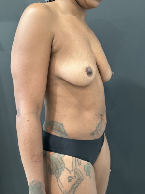 Before Image: Case #7778 – Abdominoplasty - right-front-oblique