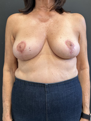 After Image: Case #7789 – Breast Lift (Mastopexy) - front