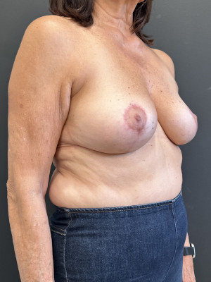 Case #7789 – Breast Lift (Mastopexy)