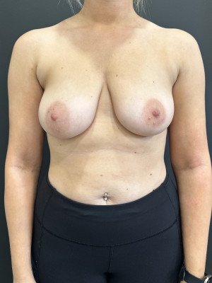 Before Image: Case #7813 – Breast Lift with Breast Augmentation - front