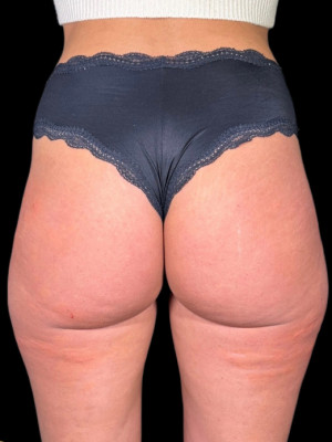 After Image: Non-Surgical BBL by Katelyn, RN - back