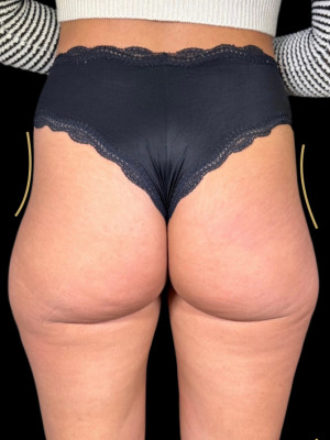 Before Image: Non-Surgical BBL by Katelyn, RN - back
