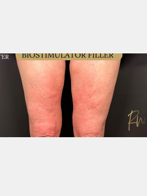 After Image: Biostimulator Filler to legs, RN - front
