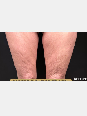 Before Image: Biostimulator Filler to legs, RN - front