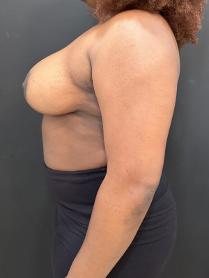 After Image: Breast Reduction - left-side