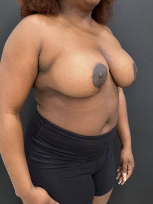 After Image: Breast Reduction - right-front-oblique