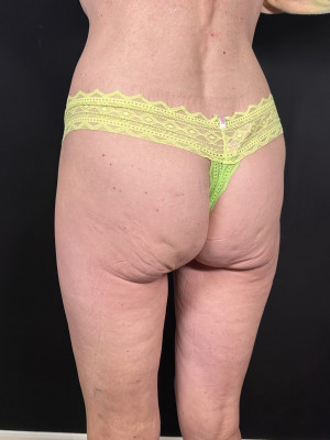 Before Image: Non-Surgical BBL - left-front-oblique