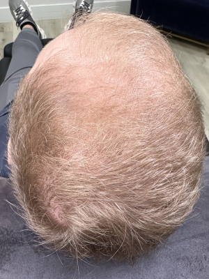 After Image: Hair Restoration - other