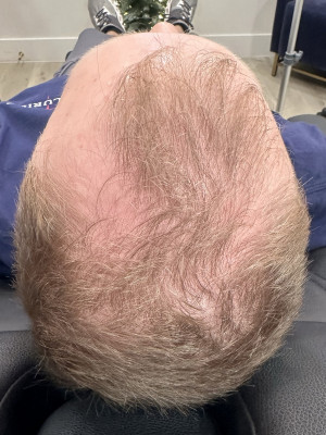 Before Image: Hair Restoration - other
