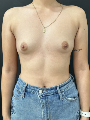 Before Image: Case #7883 – Breast Augmentation - front