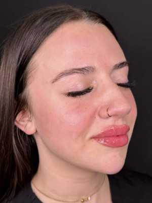 After Image: Lips & Chin by Katelyn Gross, BSN RN - right-front-oblique