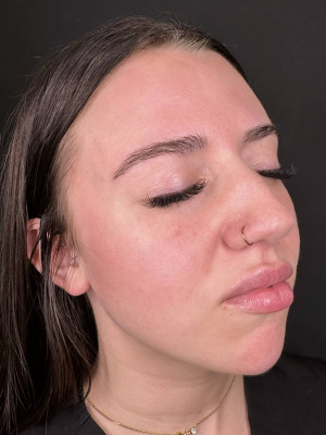 Before Image: Lips & Chin by Katelyn Gross, BSN RN - right-front-oblique