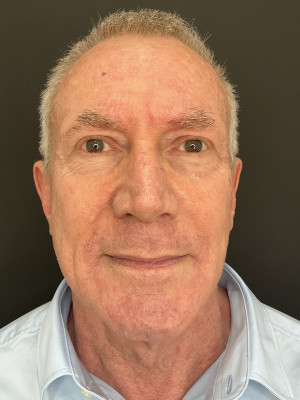 After Image: Case #7950 – Maintenance Laser - front