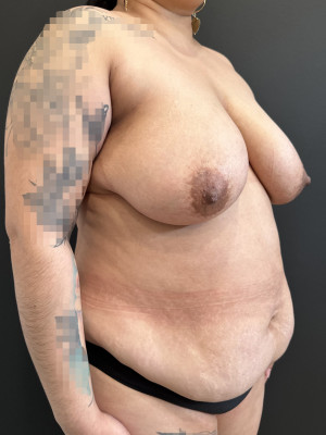 Before Image: Case #7967 – Mommy Makeover - right-front-oblique