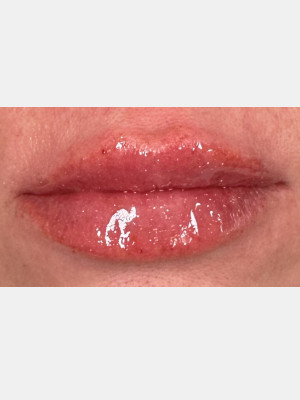 After Image: Lip Filler with Katelyn, RN - other