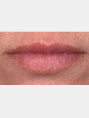 Before Image: Lip Filler with Katelyn, RN - other