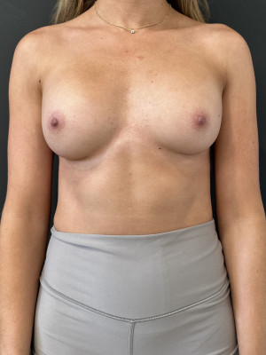 After Image: Case #8032 – Breast Augmentation - front