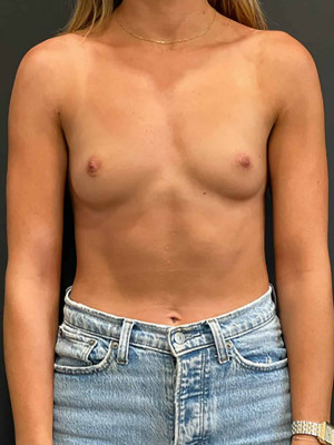 Before Image: Case #8032 – Breast Augmentation - front