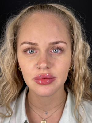 After Image: Case #8066 – Full Face Rejuvenation - front