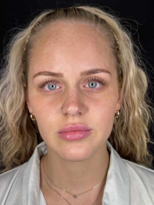 Before Image: Case #8066 – Full Face Rejuvenation - front