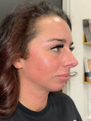 After Image: Case #8078 – Microneedling - right-front-oblique