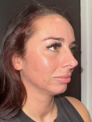 Before Image: Case #8078 – Microneedling - right-front-oblique
